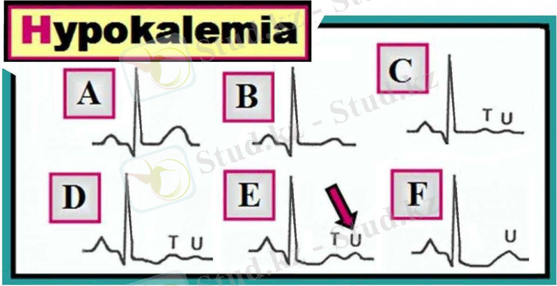 Картинки по запросу гипокалиемия