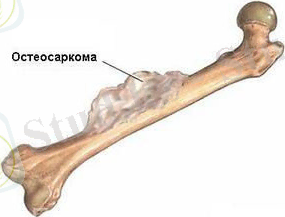 osteosarkoma-697x240.jpg