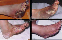  Диабеттік табан 