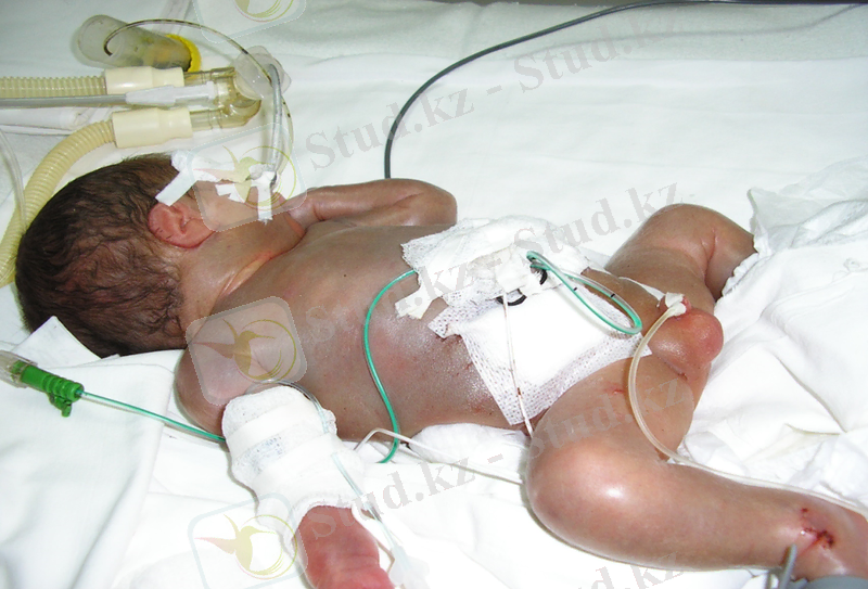 Сурет -1. Нәрестелердің гемолитикалық ауруның ісіну формасы