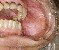https://upload.wikimedia.org/wikipedia/commons/thumb/9/96/Leukoplakia02-04-06.jpg/200px-Leukoplakia02-04-06.jpg