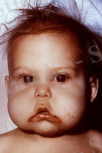 Kwashiorkor 6180.jpg