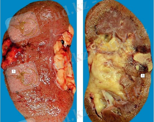 Картинки по запросу инфаркт почки