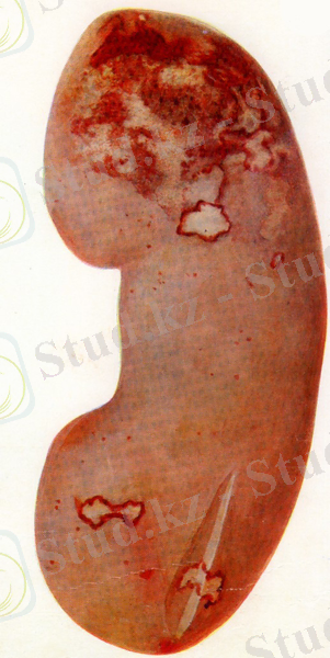 Картинки по запросу красный белый инфаркт