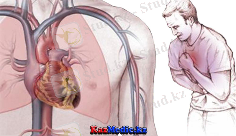 стенокардия қазақша