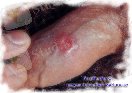 Картинки по запросу мерез ауруы