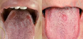 Картинки по запросу мерез ауруы