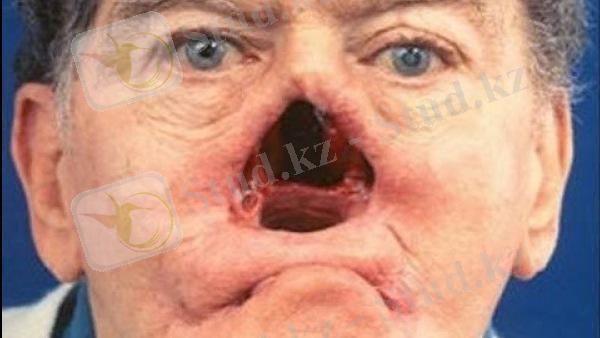 Картинки по запросу мерез ауруы