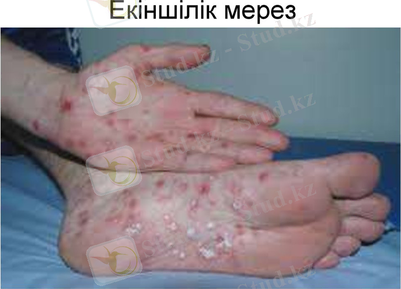 Картинки по запросу мерез ауруы