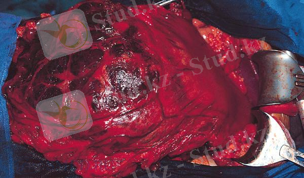 D:\Нурхан 4-курс\leyomyosarcoma gastric.jpg